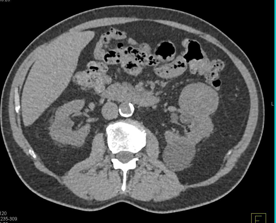 Papillary Renal Cell Carcinoma (RCC) Left Kidney and Hepatic Hemangioma - CTisus CT Scan