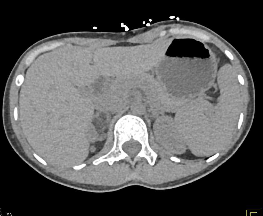 Angiomyolipoma Upper Pole Right Kidney - CTisus CT Scan