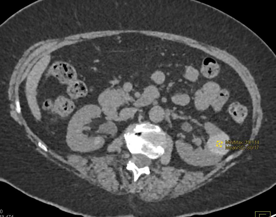 High Density Cyst Left Kidney - CTisus CT Scan
