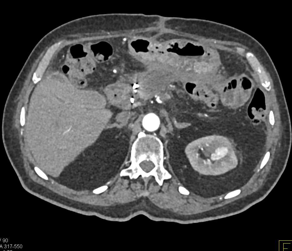 Renal Artery Pseudoaneurysm Left Kidney - CTisus CT Scan