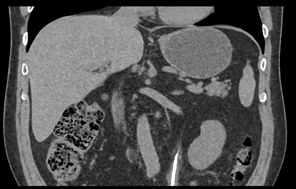 Transitional Cell Carcinoma (TCC) Left Ureter - CTisus CT Scan