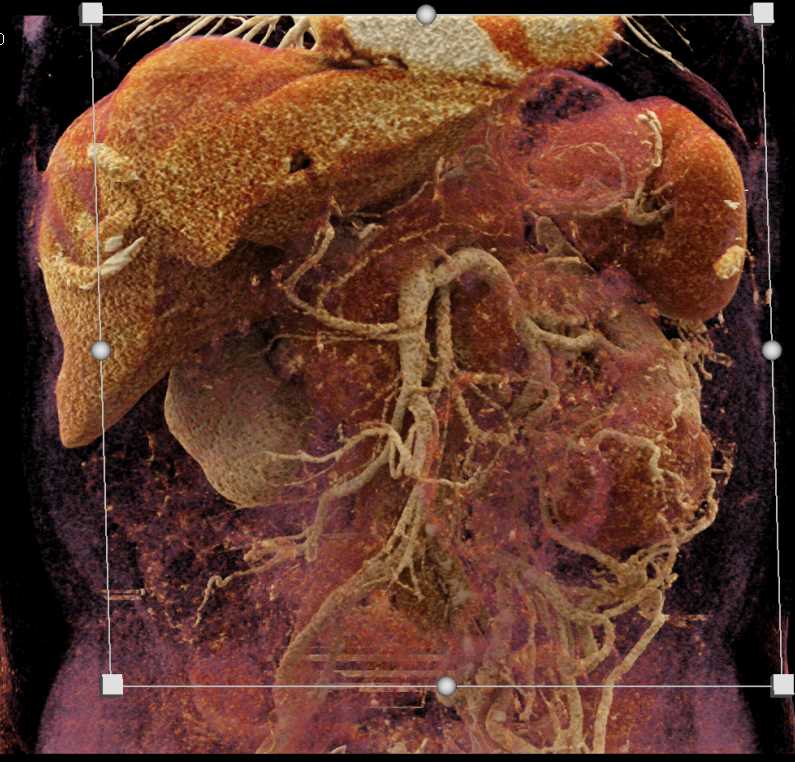 Clear Cell Left Renal Cell Carcinoma with Renal Vein Involvement - CTisus CT Scan