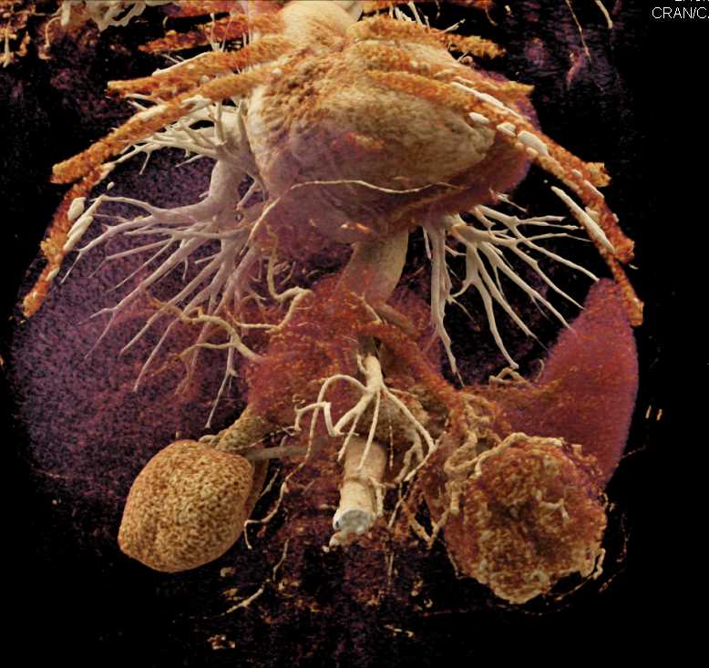 Clear Cell Left Renal Cell Carcinoma with Renal Vein Involvement - CTisus CT Scan