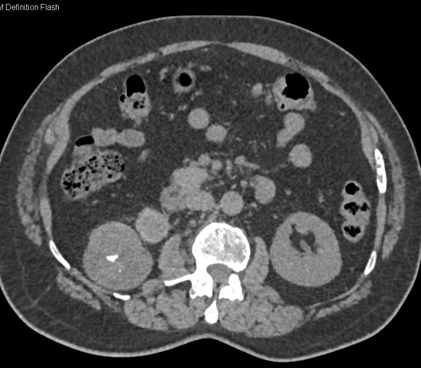 High Density Renal Cysts Right kidney - CTisus CT Scan