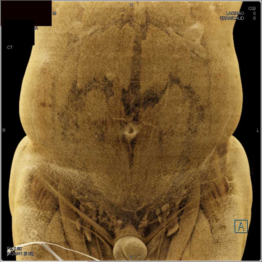 High Density Renal Cysts Right kidney - CTisus CT Scan