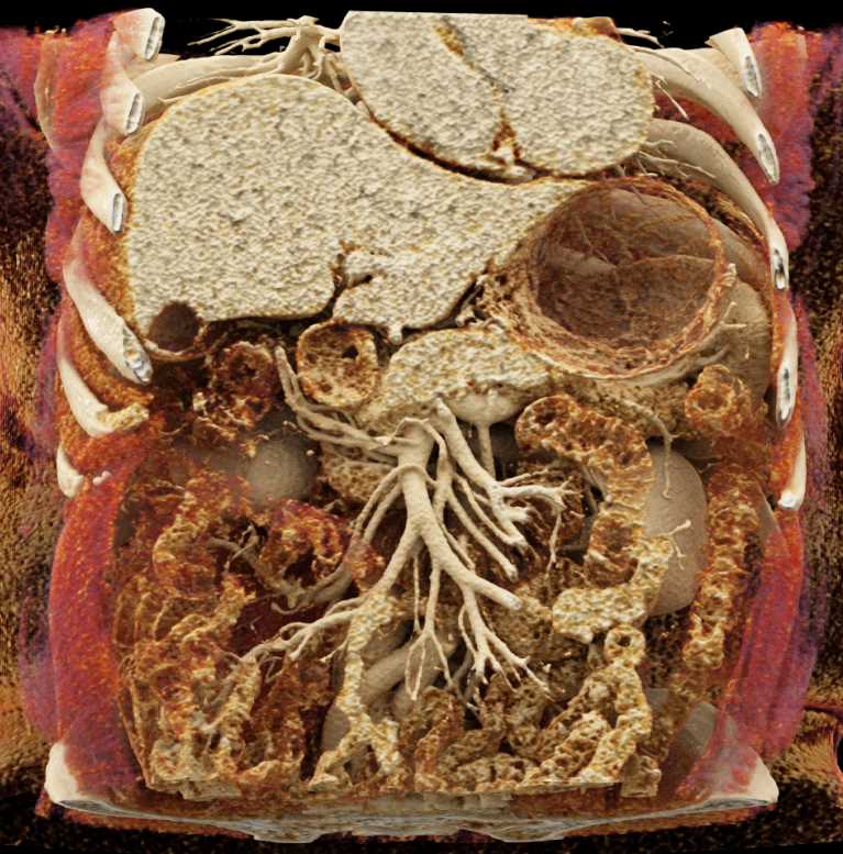 Complex Cystic Lesions Lower Pole Right Kidney - CTisus CT Scan