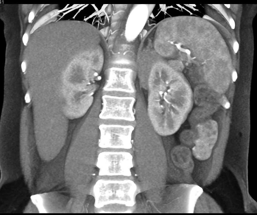 Perirenal Lymphoma Upper Pole Left Kidney - CTisus CT Scan