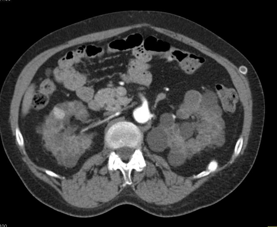 Polycystic Kidney Disease - CTisus CT Scan