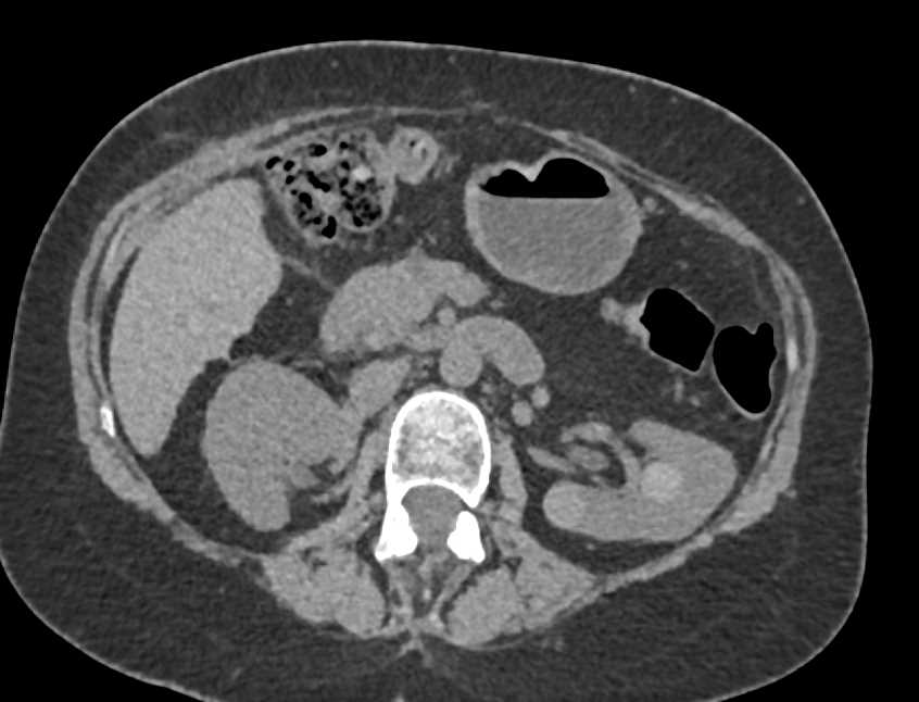 High Density Renal Cysts - CTisus CT Scan