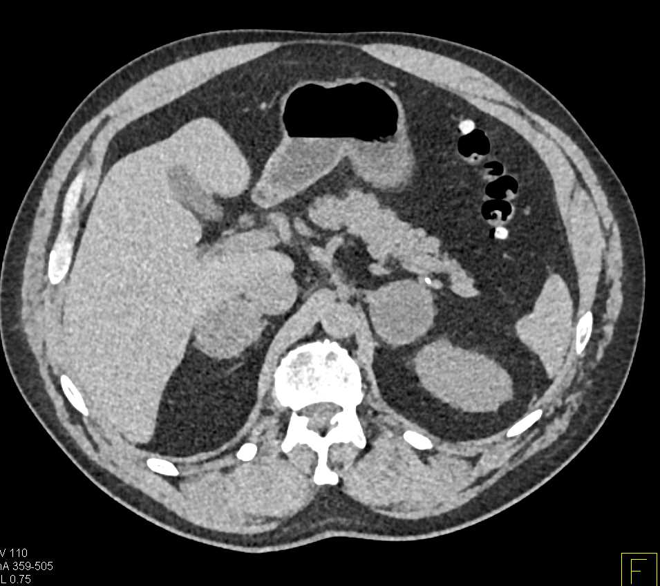 Metastatic Renal Cell Carcinoma to the Adrenal Glands - CTisus CT Scan