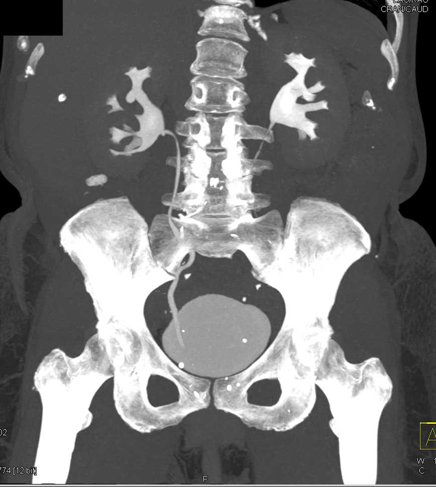 Angiomyolipoma Right Kidney - CTisus CT Scan