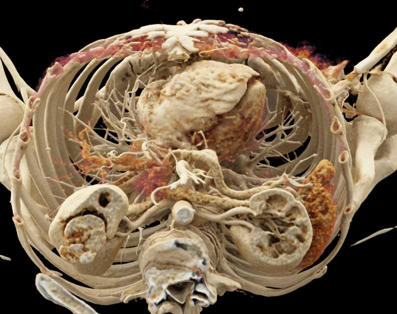 Oncocytoma Lower Pole of the Right Kidney with Cinematic Rendering - CTisus CT Scan