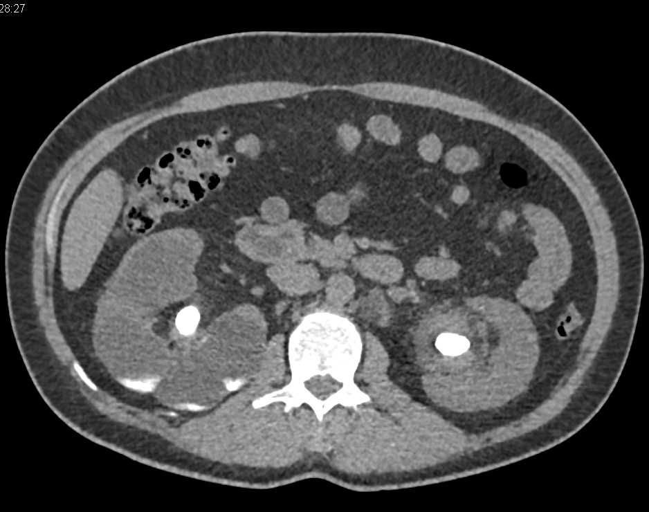Focal Xanthogranulomatous Pyelonephritis (XGP) Right Kidney - CTisus CT Scan
