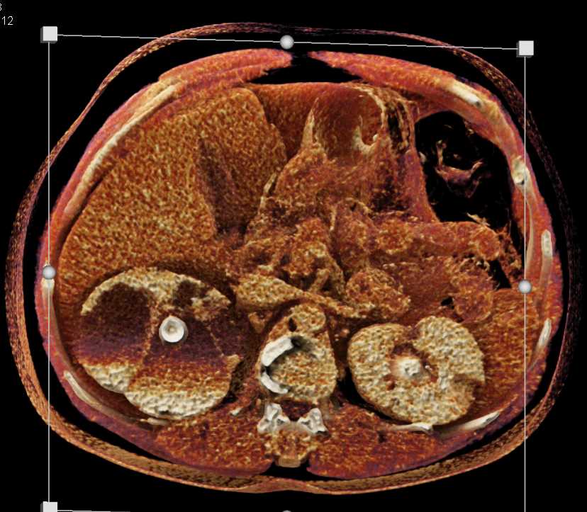Focal Xanthogranulomatous Pyelonephritis (XGP) Right Kidney - CTisus CT Scan