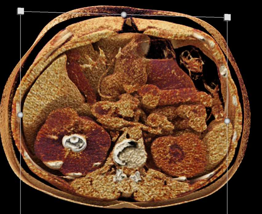Right Staghorn Calculus with Pyelonephritis with Cinematic Rendering - CTisus CT Scan