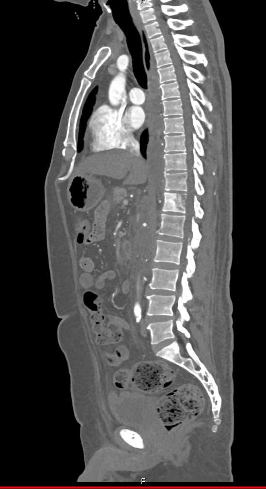 Invasive Renal Cell Carcinoma - CTisus CT Scan