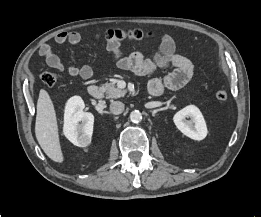 1 Cm Left  Renal Carcinoma - CTisus CT Scan