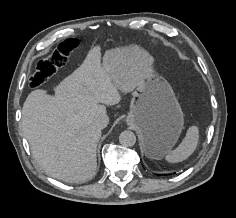 1 Cm Right Renal Carcinoma of High CT Attenuation of the Non Contrast Scans - CTisus CT Scan