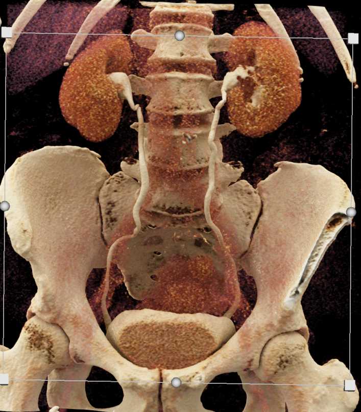 Transitional Cell Carcinoma Left Kidney with Cinematic Rendering - CTisus CT Scan