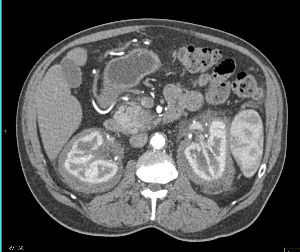 Erdheim-Chester disease - CTisus CT Scan
