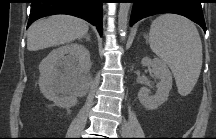 Inflammation Bladder and Ureter - CTisus CT Scan
