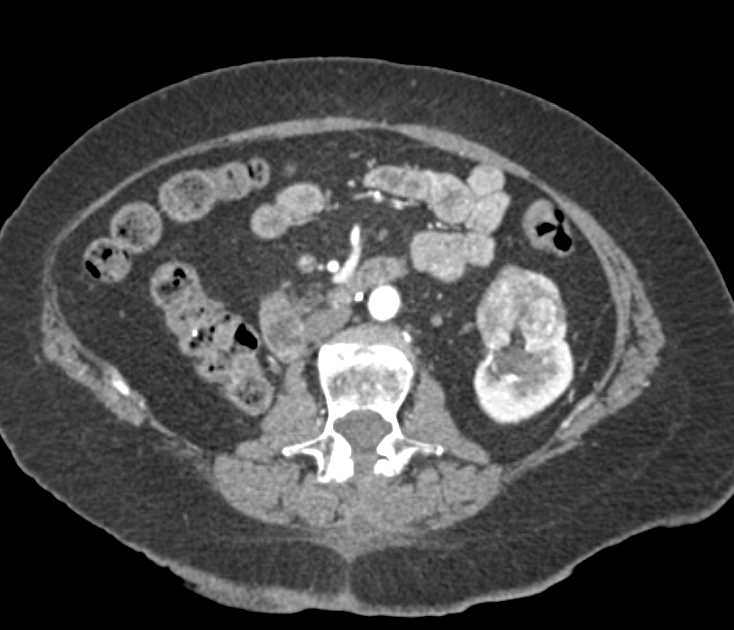 Clear Cell Renal Cell Carcinoma with Renal and Adrenal Metastases - CTisus CT Scan