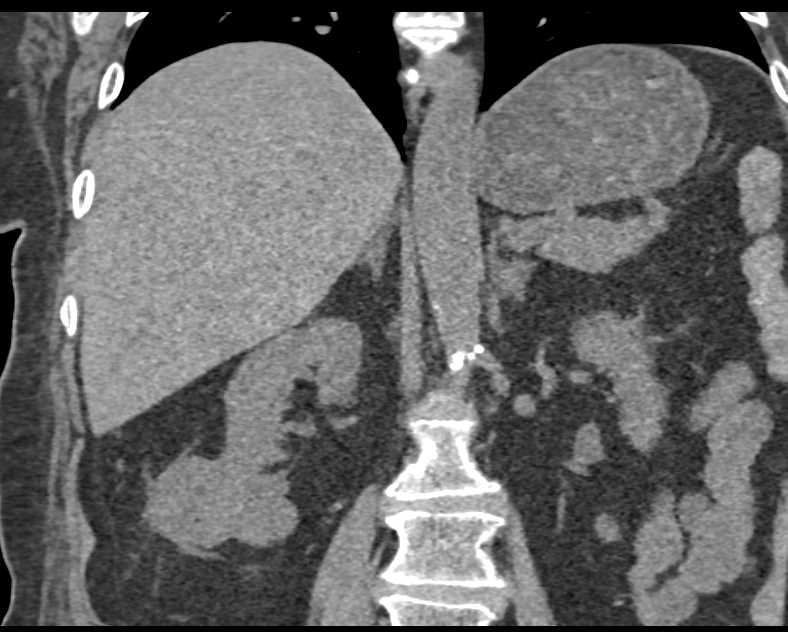 Clear Cell Renal Cell Carcinoma Right Kidney - CTisus CT Scan