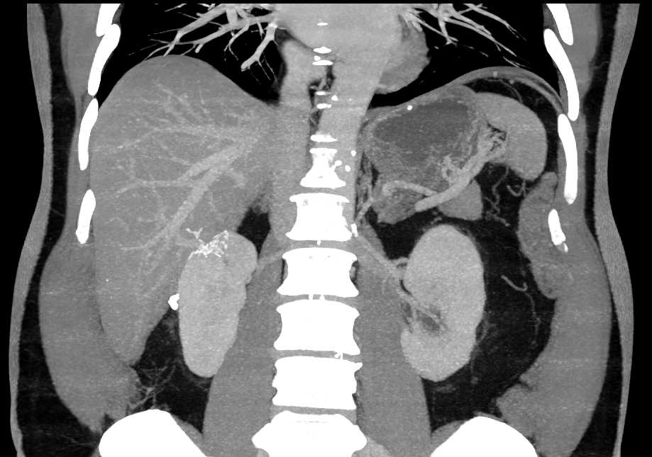 Scarring of the Upper Pole of the Right Kidney - CTisus CT Scan