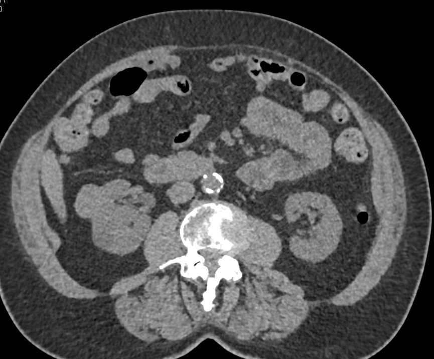 High Density Right Renal Cyst - CTisus CT Scan