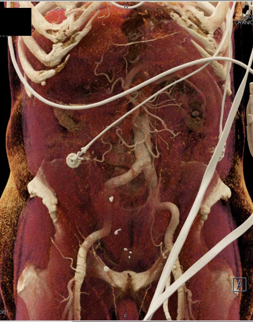 Multiple Renal Cysts with Cinematic Rendering - CTisus CT Scan