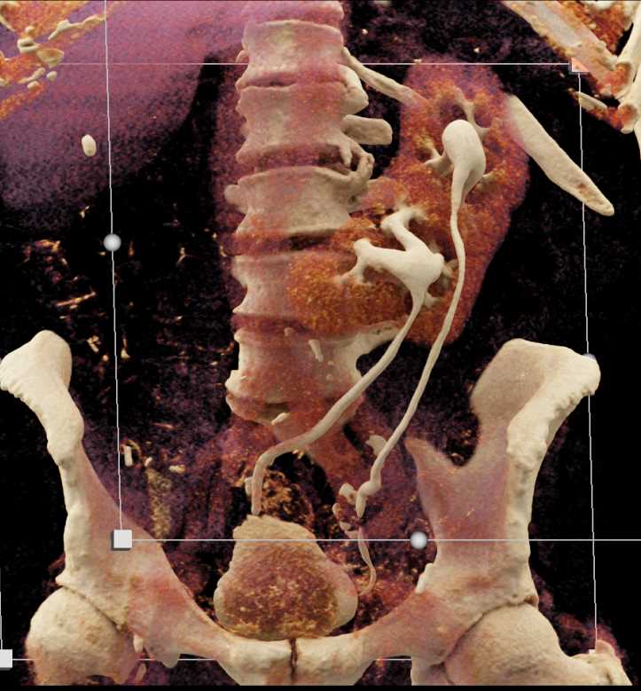 Crossed Renal Ectopia - CTisus CT Scan