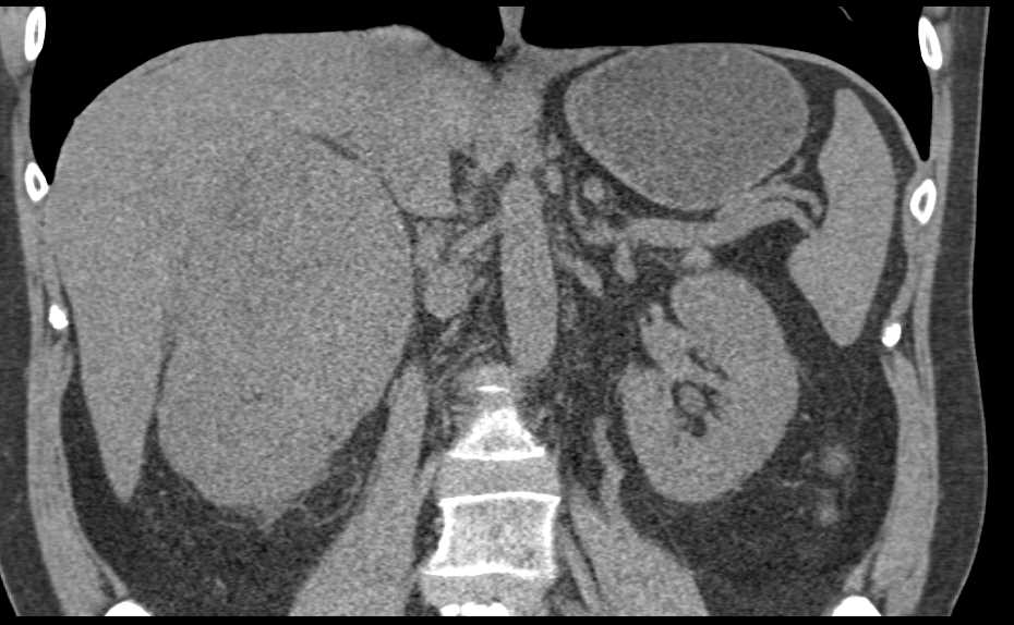 Cystic Renal cell carcinoma - CTisus CT Scan