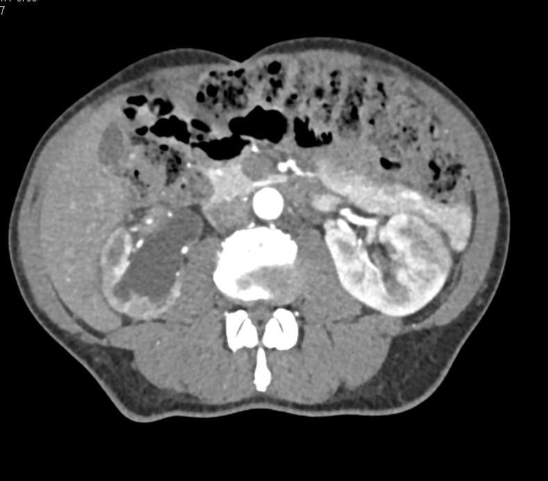Acute Pyelonephritis Left Kidney - CTisus CT Scan