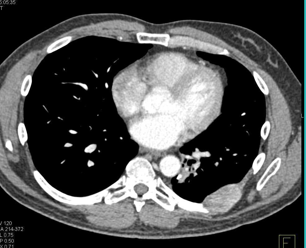 Metastatic Renal Cell Carcinoma to Bone and Pancreas - CTisus CT Scan