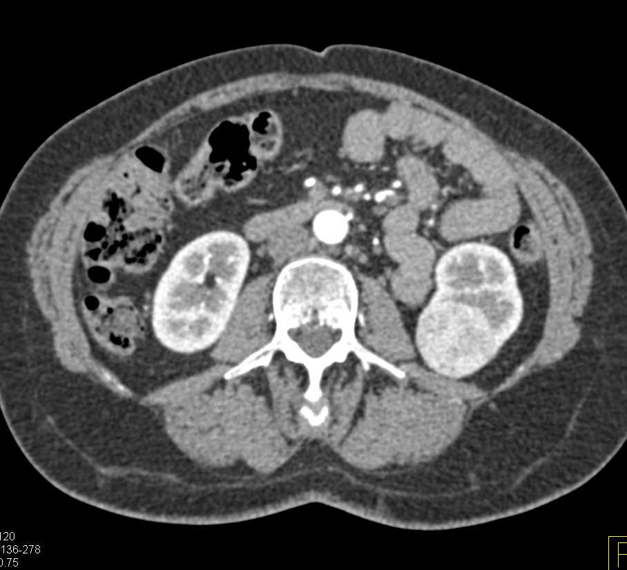 Oncocytoma Lower Pole Left Kidney - CTisus CT Scan