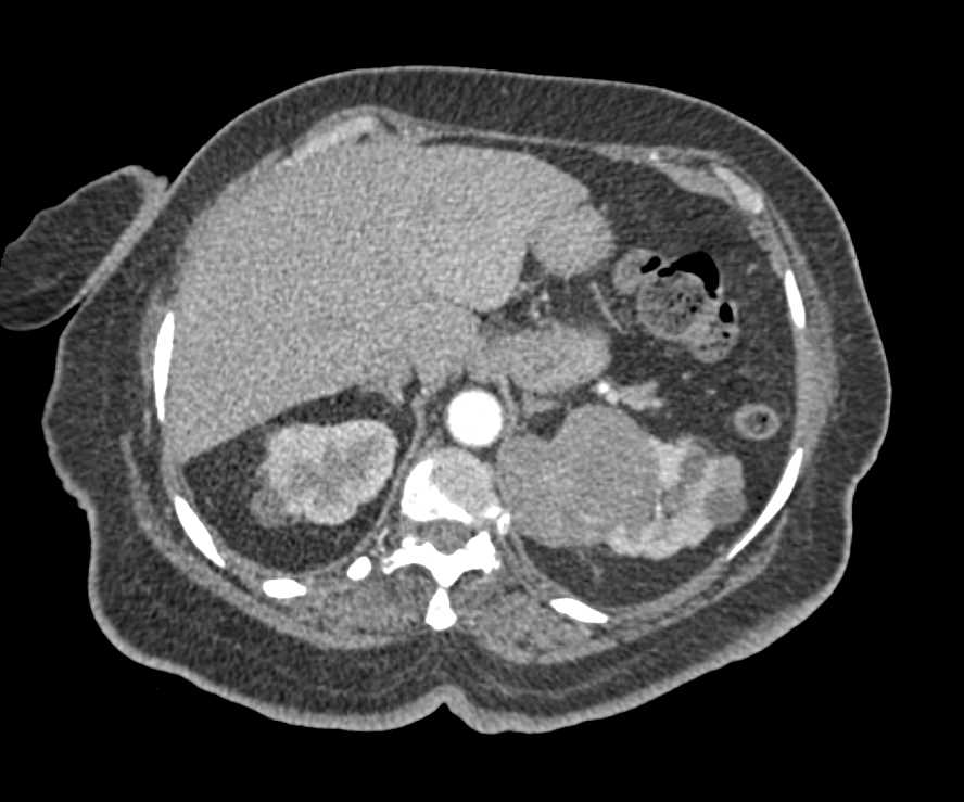 Papillary Renal Cell Carcinoma - CTisus CT Scan