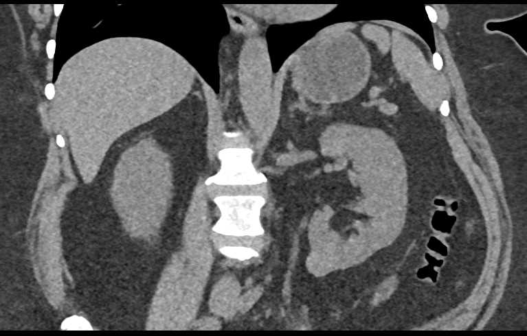 High Density Renal Cyst Lower Pole Left Kidney - CTisus CT Scan