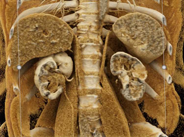 Transitional Cell Carcinoma Right Kidney and Bladder - CTisus CT Scan