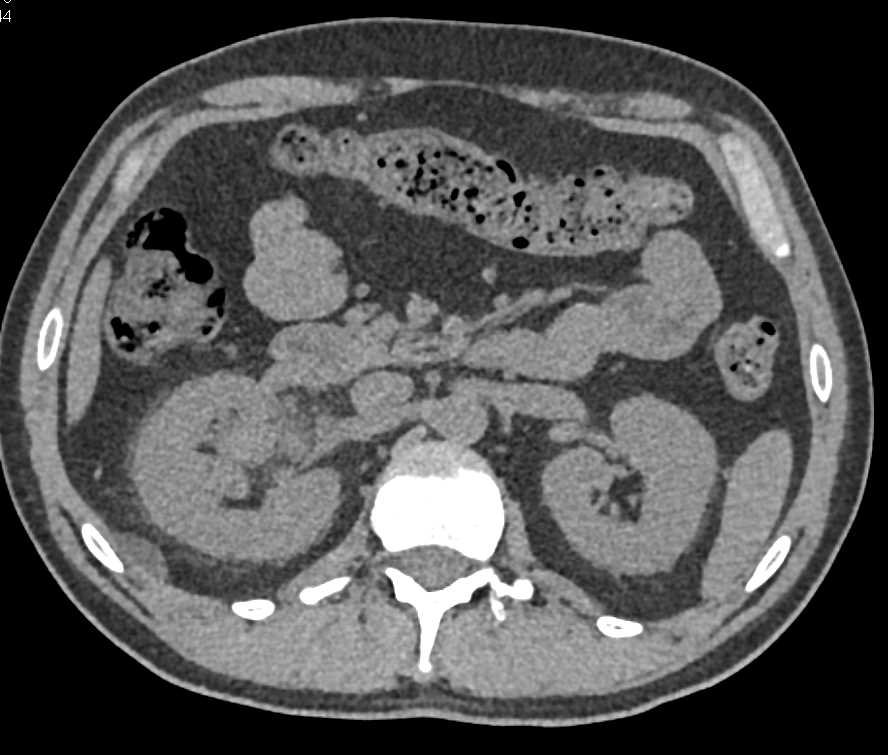 AV Fistulae Right Kidney - CTisus CT Scan