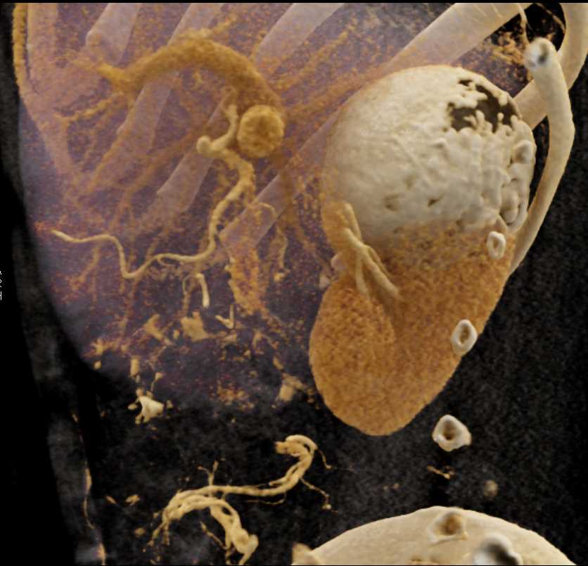 Calcified Cyst Right Kidney - CTisus CT Scan