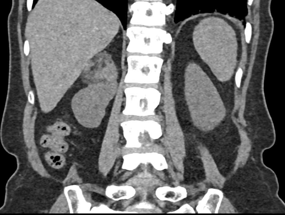Angiomyolipoma Upper Pole Right Kidney - CTisus CT Scan