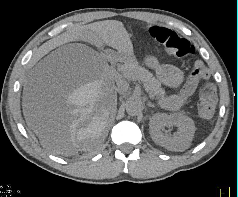 Spontaneous Right Renal Bleed in an AML - CTisus CT Scan