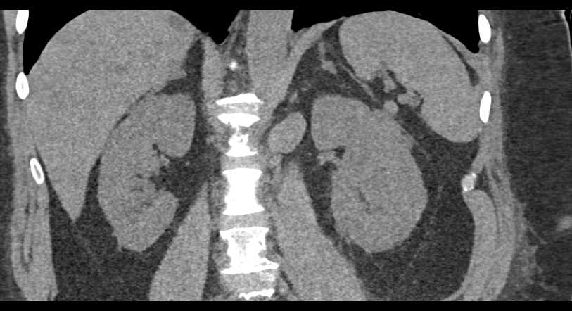 Transitional Cell Carcinoma Left Kidney with Bone Mets - CTisus CT Scan