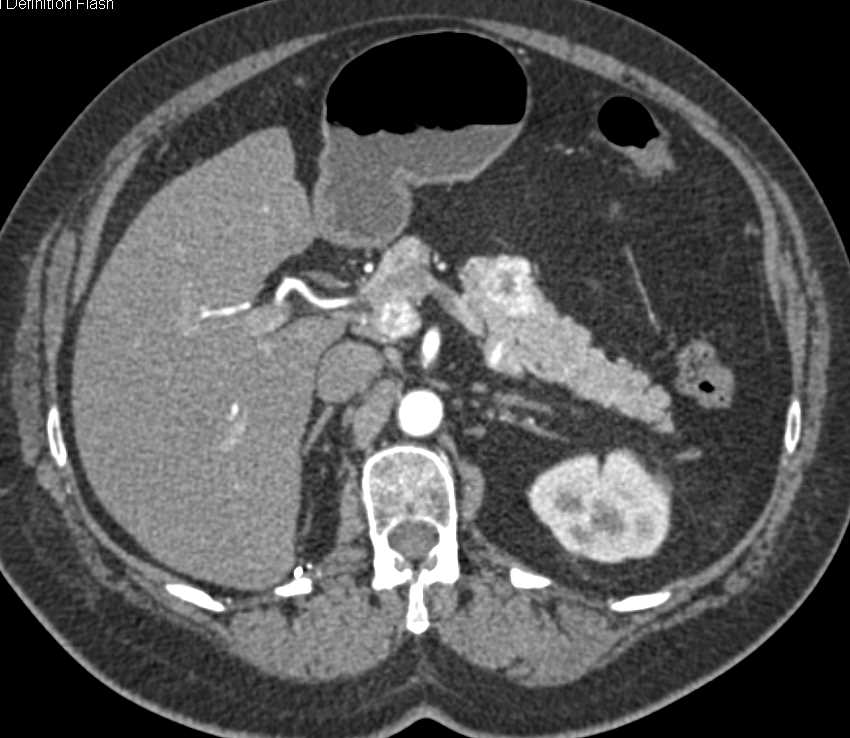 Metastatic Renal Cell Carcinoma to Pancreas and Bone - CTisus CT Scan