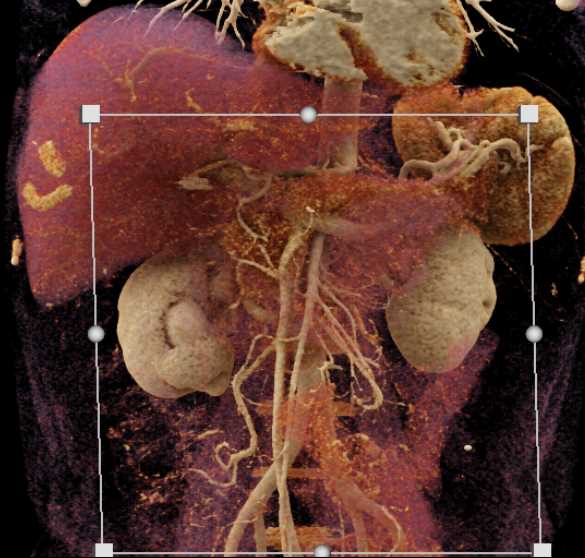 AV Fistulae Right Kidney - CTisus CT Scan