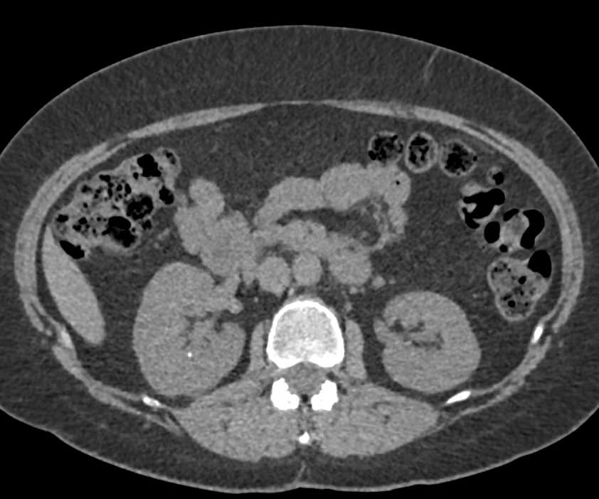 AV Fistulae Right Kidney - CTisus CT Scan