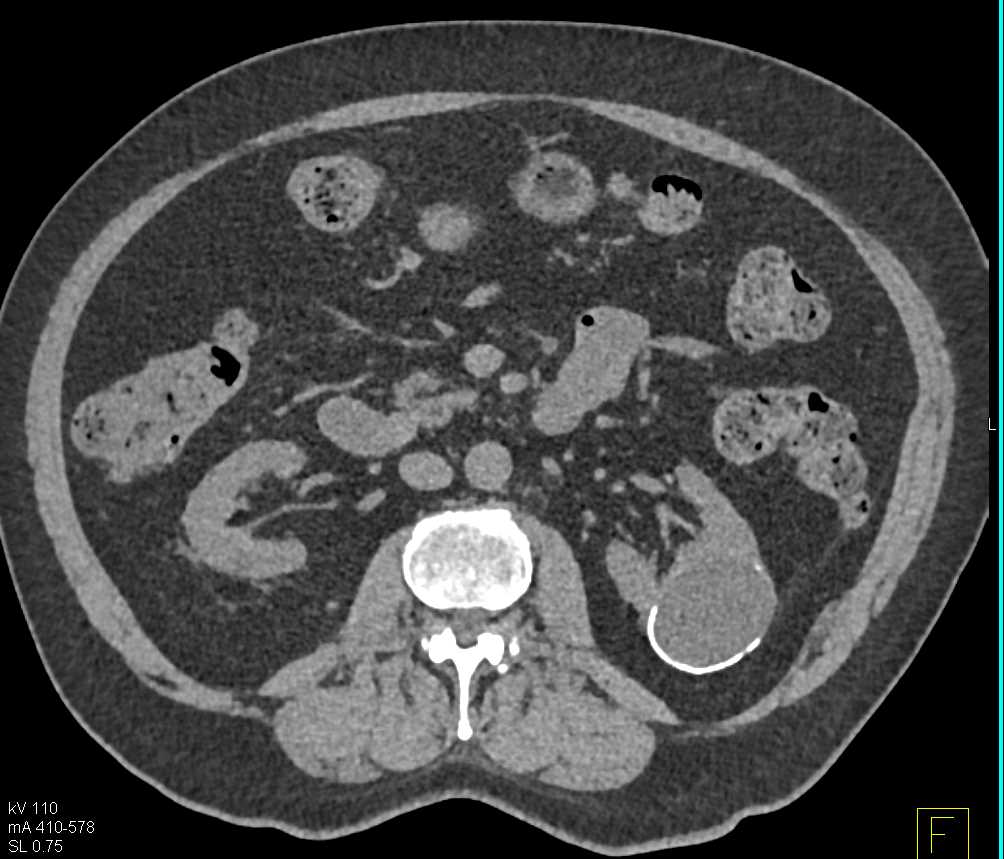 Bosniak 2 Renal Cyst - CTisus CT Scan