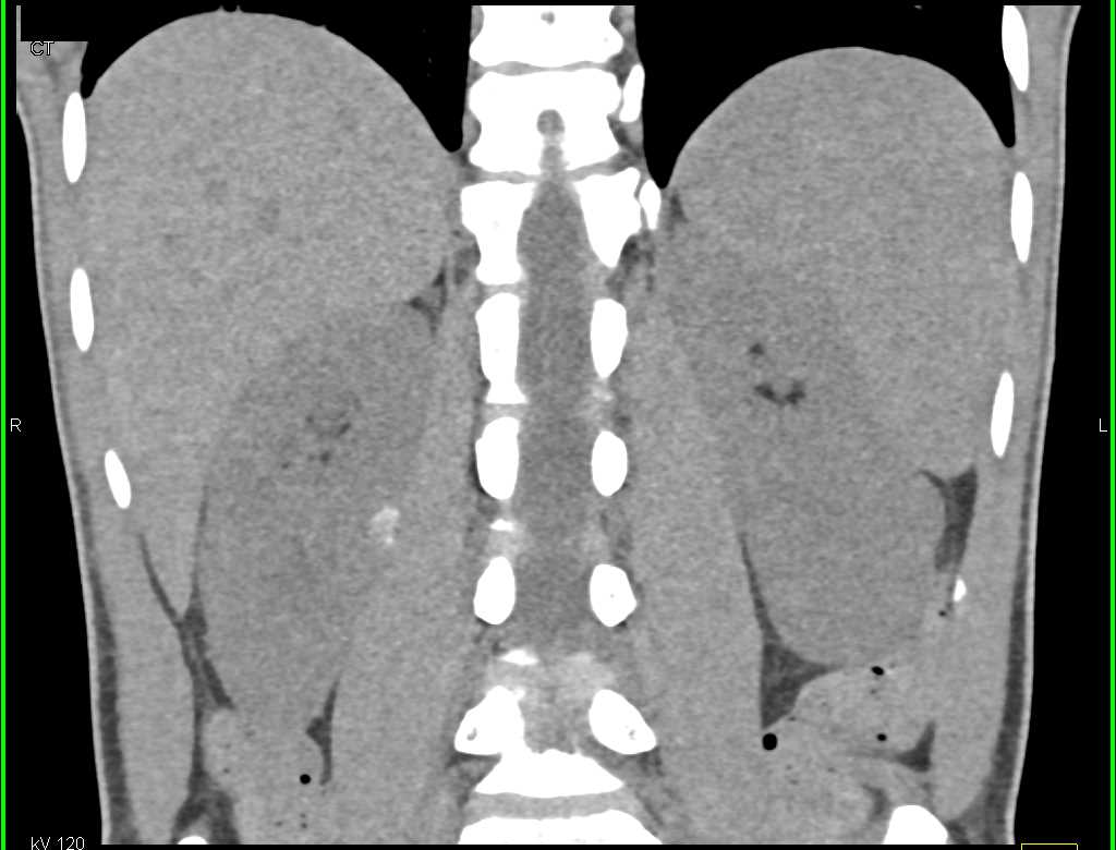 Transitional Cell Carcinoma - CTisus CT Scan