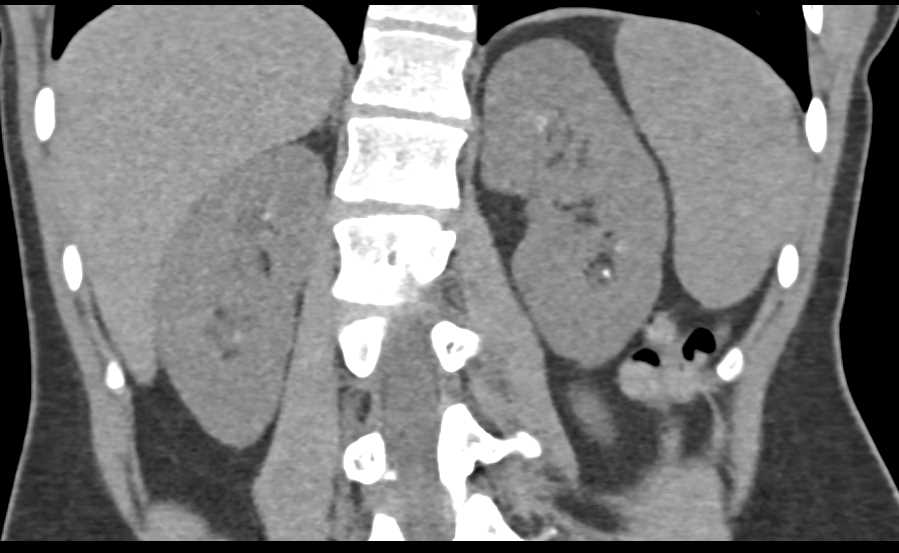 Papillary Necrosis - CTisus CT Scan