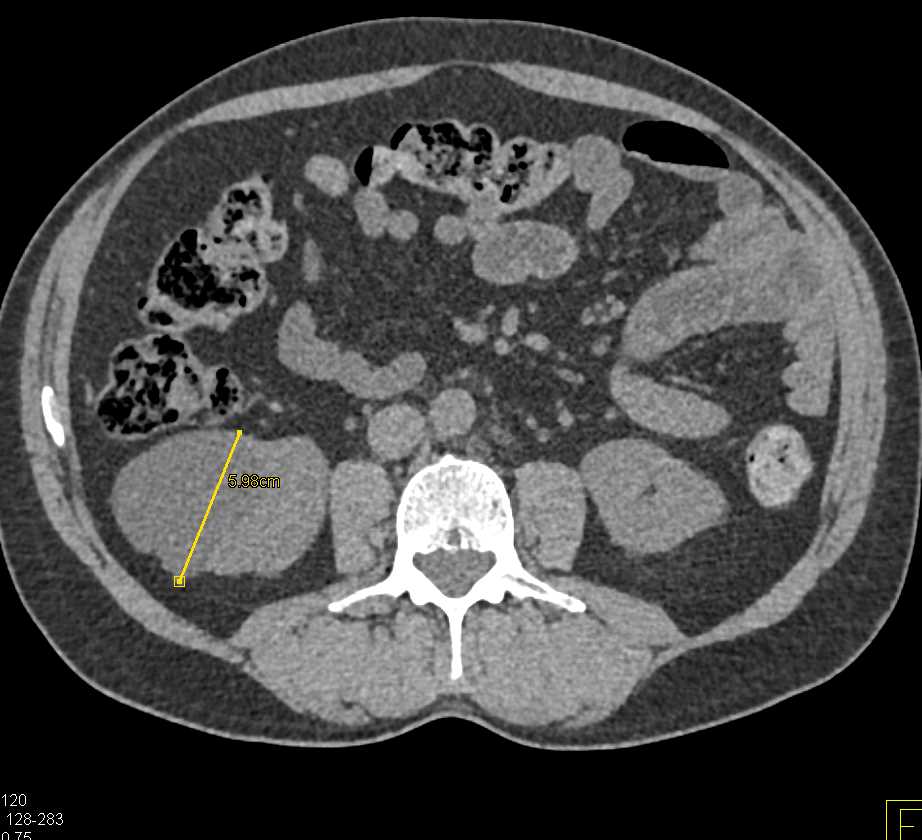 Bosniak 1 Renal Cyst - CTisus CT Scan